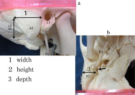 Ear Anatomy Mastoid