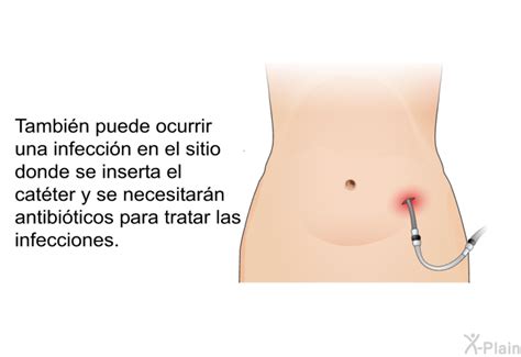 Patedu Acceso De Cat Ter Para Di Lisis Peritoneal