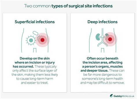 Infection From Surgery Claims Solicitors Essex And Uk Gadsby Wicks