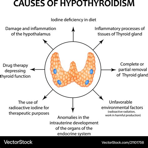 Causes of thyroid hypothyroidism infographics Vector Image