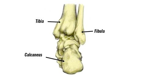 Calcaneal Stress Fracture Symptoms Causes And Treatment