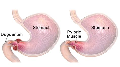 Pyloric stenosis - Clinical features - Management - TeachMePaediatrics