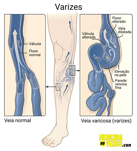 Varizes Nas Pernas Ou Vasinhos Causas Sintomas E Tratamento