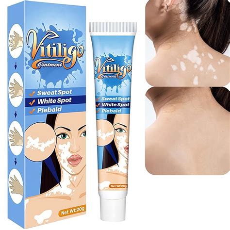 Vitiligo Cream Vitiligo Treatment For Skin Vitiligo