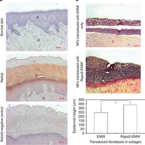 Histological Analysis Of Normal Skin Keloids And Organotypic Skin Download Scientific Diagram