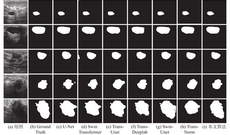 融合cnn和vit的乳腺超声图像肿瘤分割方法