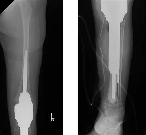 Proximal Tibia Tumor Prosthesis Replacement