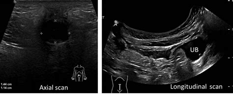 Infected Patent Urachus Radiology Cases