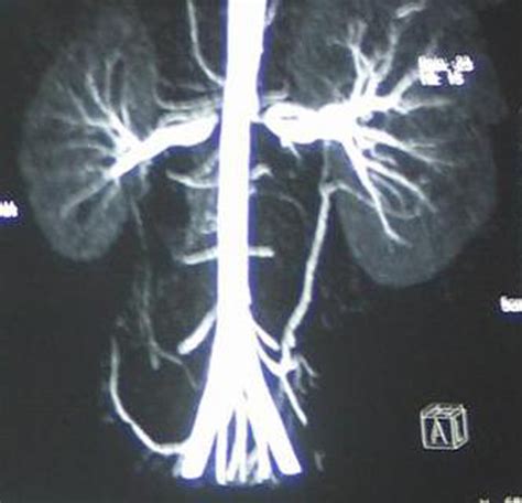 Computed Tomography Angiography Of The Renal Arteries Severe Stenosis Download Scientific