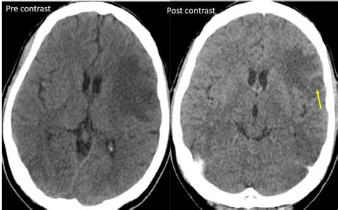 Septic Embolic Encephalitis Radiology Cases