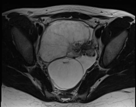 Ovarian Torsion Image