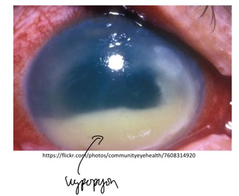 Eye Pathology Flashcards Quizlet