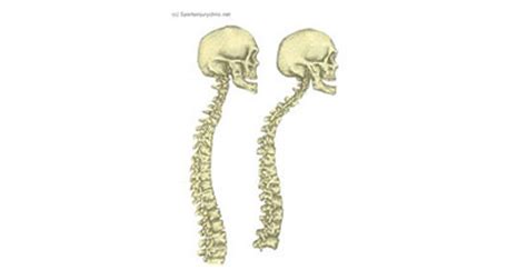 Scheuermann S Disease Symptoms Causes And Treatment