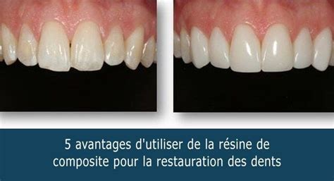 5 Avantages Dutiliser De La Résine De Composite Pour La Restauration