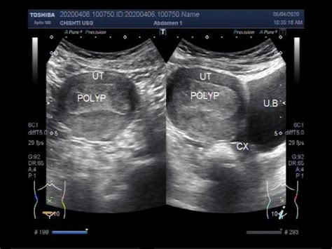 Cervical Polyps Causes Symptoms Treatment Cervical Polyps