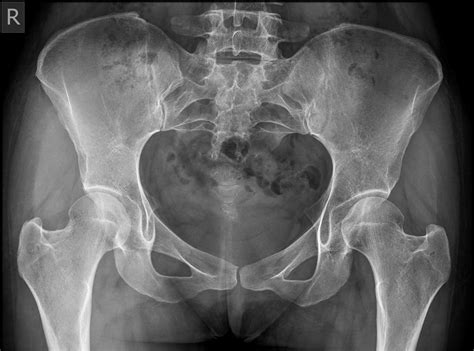 Sacrum Xray