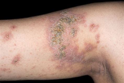 Lesions On Upper Arms Atopic Dermatitis Challenge Center