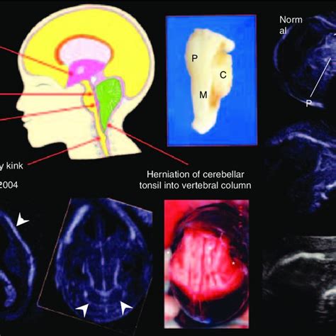 Chiari Type Ii Malformation Schematic Picture Of Chiari Type Ii Download Scientific Diagram