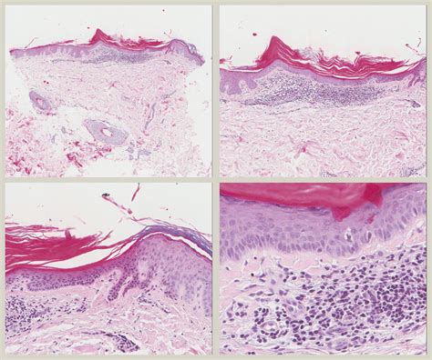 Hyperkeratosis Lenticularis Perstans Flegel Disease Diagnostic