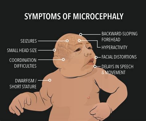 Slowed cell division causes microcephaly