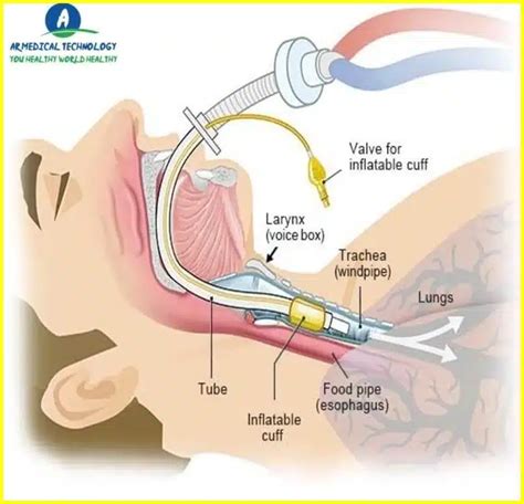 Ventilator Definition Best Way To Learn 24 Ar Medical Technology