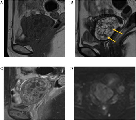 Figure 1 From A Case Of Uterine Adenomyoma Of Endocervical Type That