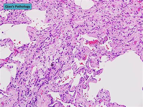 Qiaos Pathology Metastatic Gastric Signet Ring Cell Carcinoma To