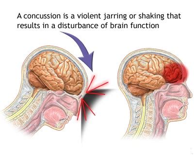 Signs Symptoms Of Concussions And How To Treat It