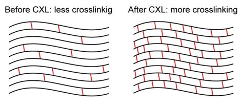 Collagen Crosslinking London — Advanced Vision Surgery