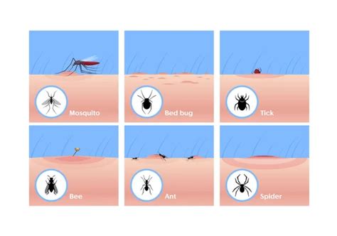 Picaduras De Insectos Vector Plano Ilustraciones Conjunto Mosquito