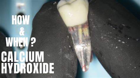 When And How To Use Calcium Hydroxide In Endodontics Various Ways To