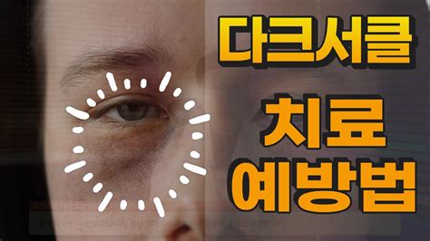 다크서클 색과 형태를 치료해야 하는 경우 치료방법 ｜다크서클 예방 지우기 Youtube