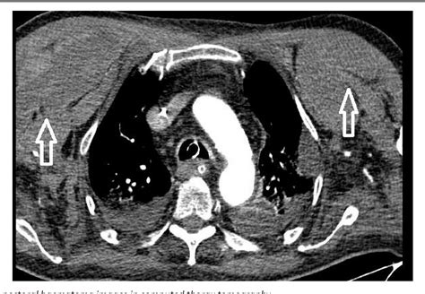 Figure 1 From Case Series Of Pectoral Hematoma Associated With