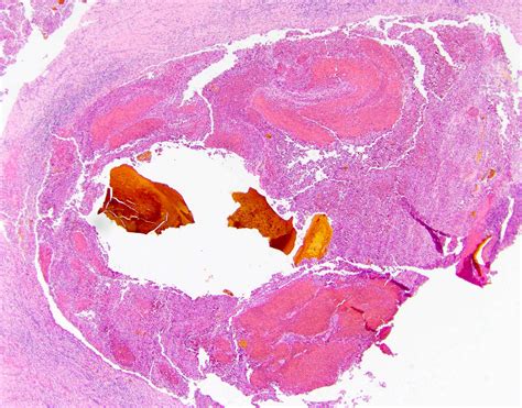 Pathology Outlines Primary Sclerosing Cholangitis