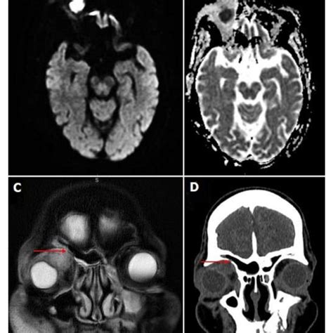 A Axial Diffusion Weighted Imaging Mri Of The Orbits Without Contrast