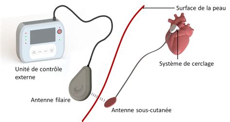 NeoCare Implant Cardiaque Innovant Cherche Industriel DeviceMed Fr