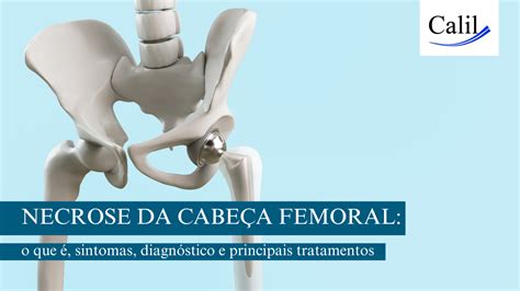 Necrose Da Cabe A Femoral O Que Sintomas Diagn Stico E Principais