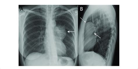 53 Year Old Woman With Thymoma A B Frontal Chest Radiograph A