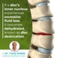 What Is Disc Desiccation? Causes, Symptoms, and Treatment