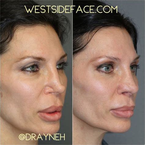 Complex Reconstructive Rhinoplasty