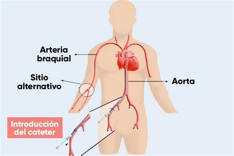 Cateterismo Card Aco Qu Es C Mo Se Hace Y Cuidados Tua Sa De