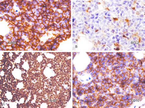 Photomicrography Immunohistochemistry Burkitt Lymphoma Cells