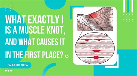 What Are Muscle Knot How To Relieve A Muscle Knot YouTube