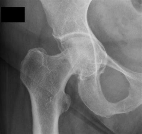 Fai Pincer And Protrusio Acetabuli Deepened Acetabular Fossa