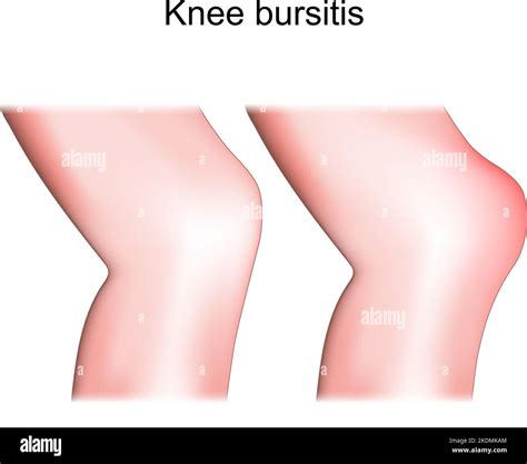 Bursitis de rodilla Bursitis prepatelar Diferencia y comparación de la