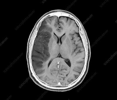 Stroke vs Normal Brain MRI Mri shows 'brain scars' in military personnel with blast-related ...