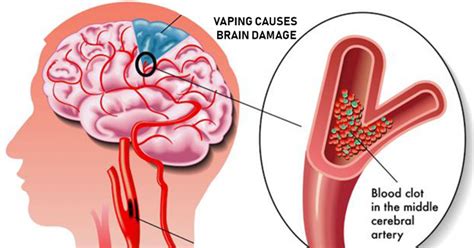 The New Research Reveals That Vaping Causes Lung And Brain Damage