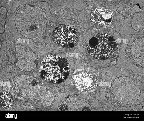 Apoptosis Cell Death Transmission Electron Micrograph Tem Of A