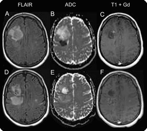 Gadolinium Deposition Disease Class Action Lawsuit | Gadolinium Deposition Disease Lawsuits