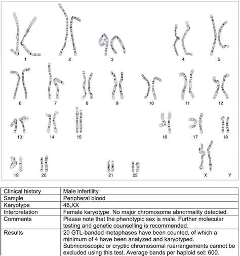 XX Testicular Disorder Of Sex Development DSD Presenting With Male Hypogonadism PMC